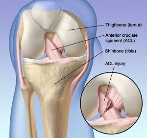 ACL diagram